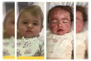Bebê ficar com rosto desfigurado após reação alérgica a medicamento