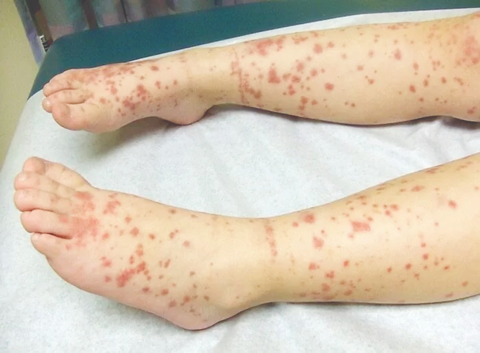 Foto: Criança apresentou
sintomas após retornar
com a família, para
Campo Grande/Reprodução