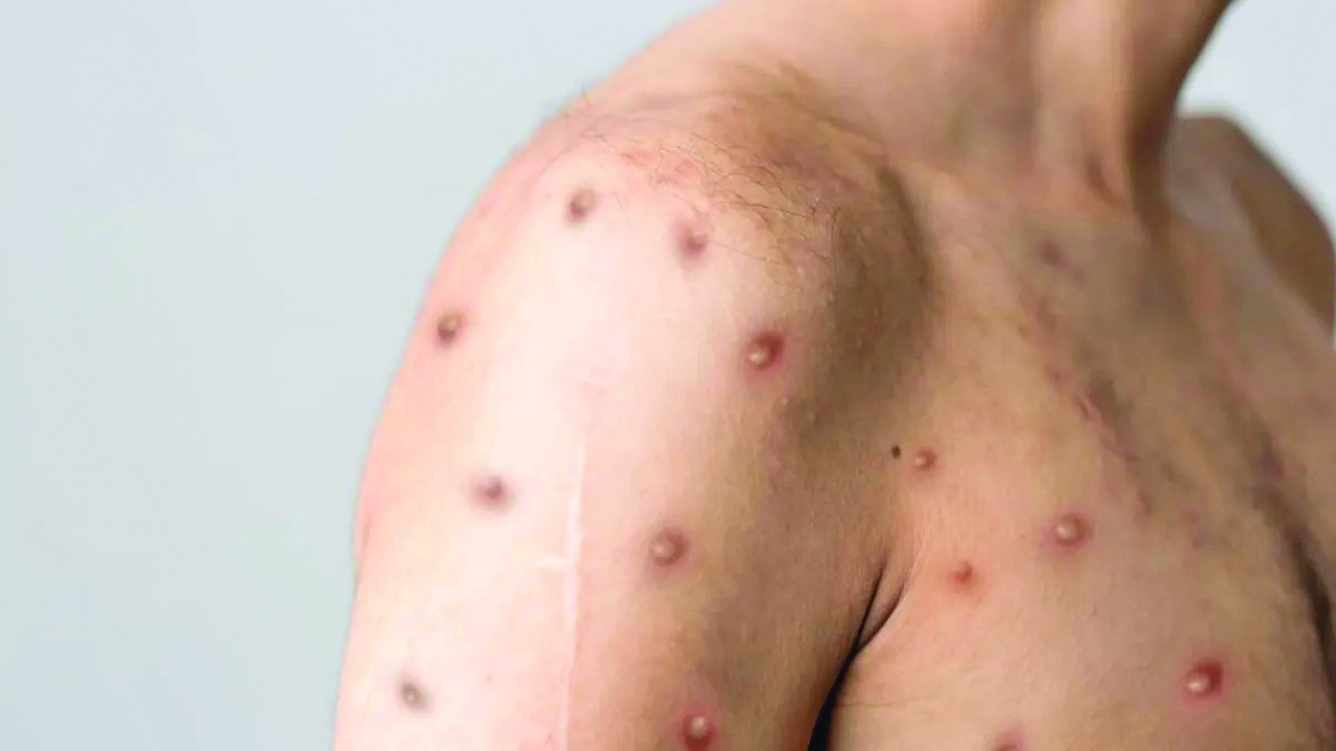 Sesau confirma o primeiro caso suspeito para Mpox na Capital