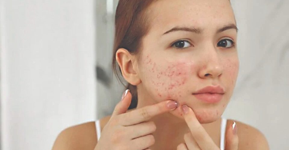 Para quem sofre com acnes, SUS oferece tratamento completo e gratuito no Estado  - Foto: reprodução/internet