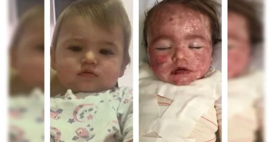 Bebê ficar com rosto desfigurado após reação alérgica a medicamento